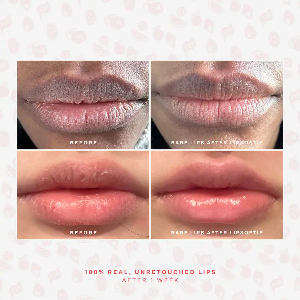 SOS LipSoftie® Lip Treatment